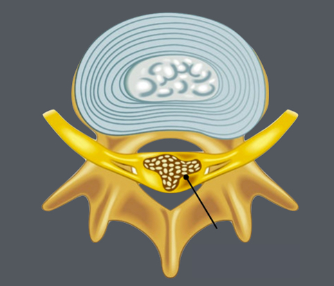 Stenosis.jpg