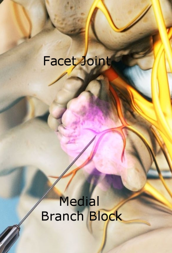 medial-branch-nerve-block-procedure (1).jpeg