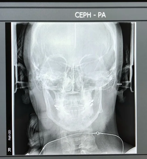 My very first x-rays. You can see here how my left joint is shorter than the right & my entire jaw was “canted” or tilted. This caused severe pain, difficultly chewing, neck issues, headaches, & lock-jaw. All TMJ symptoms,