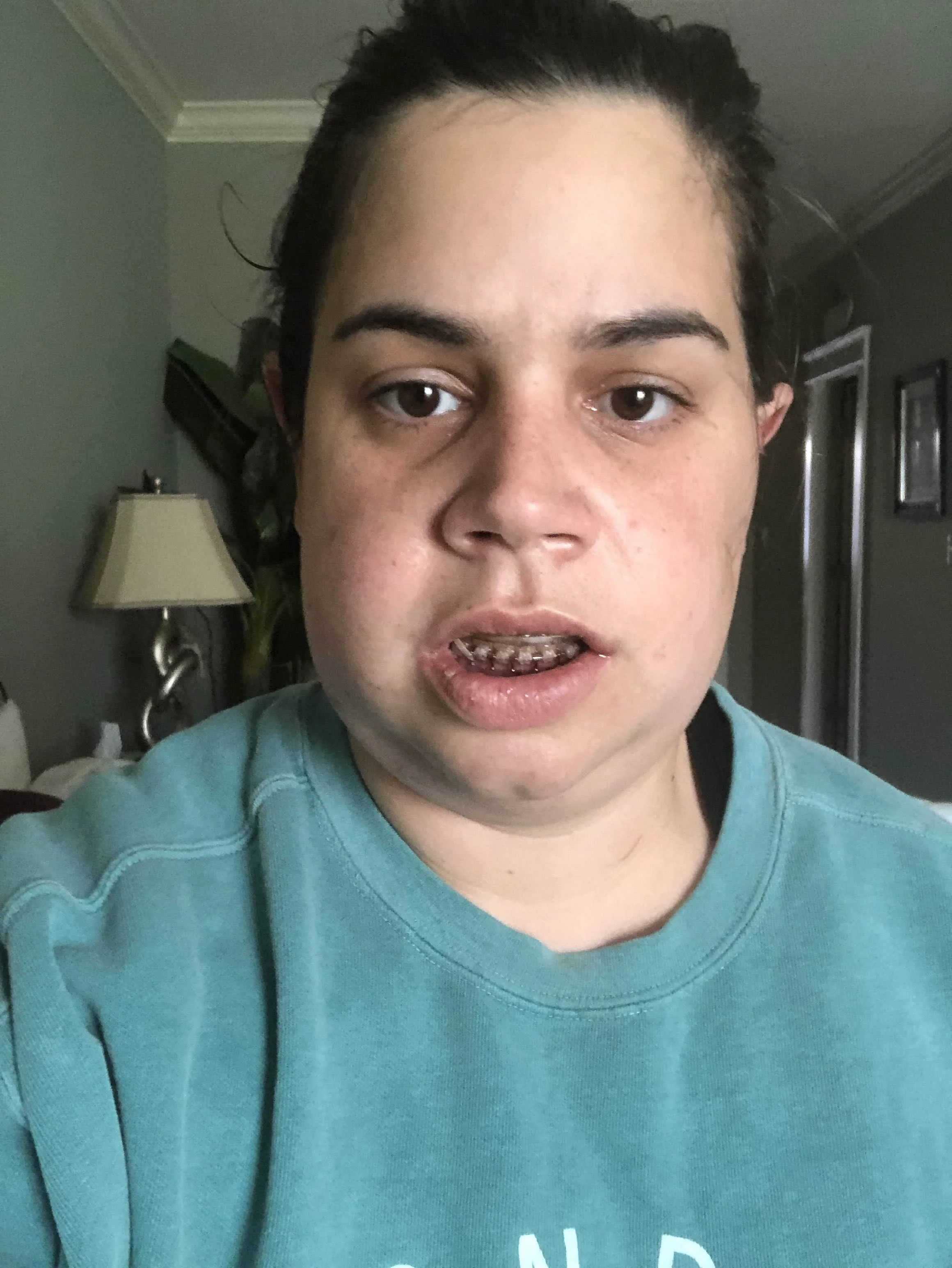 This was from Friday Morning at Christy’s house. Technically day 2 post op but day 1 after discharge. The timing is hard to track since it happened so early in the morning.
