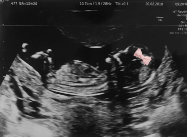 We're Having Another Baby!