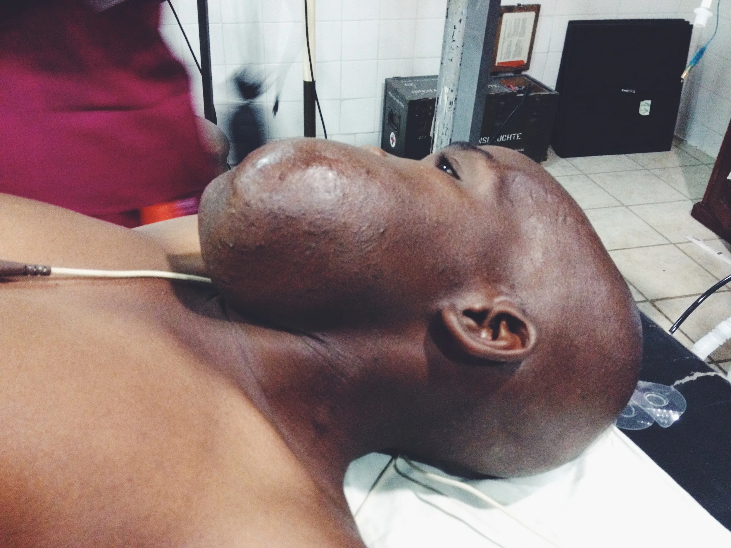 This mans mandibular tumour was removed, along with 3/4 of his jaw. A rib was taken from him to use as a graft and replace what was his jaw. The surgery was a total success! 