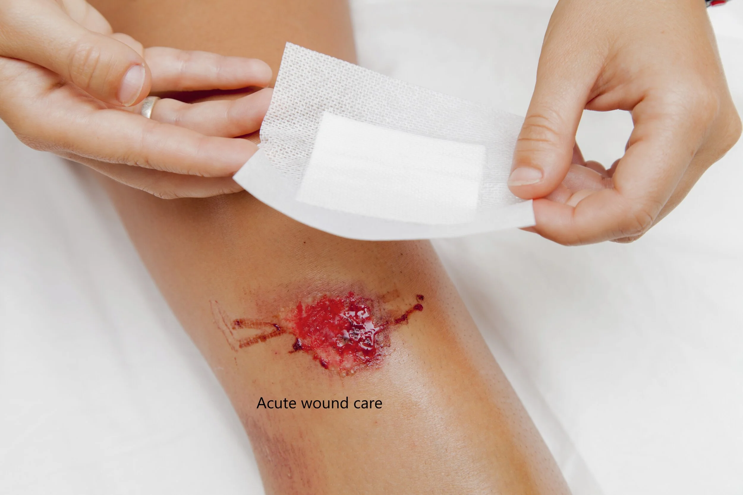 Acute wound care.jpg