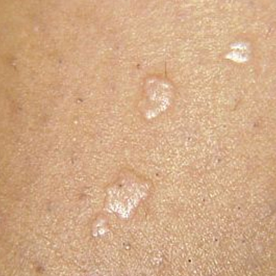papillomavirus skin warts