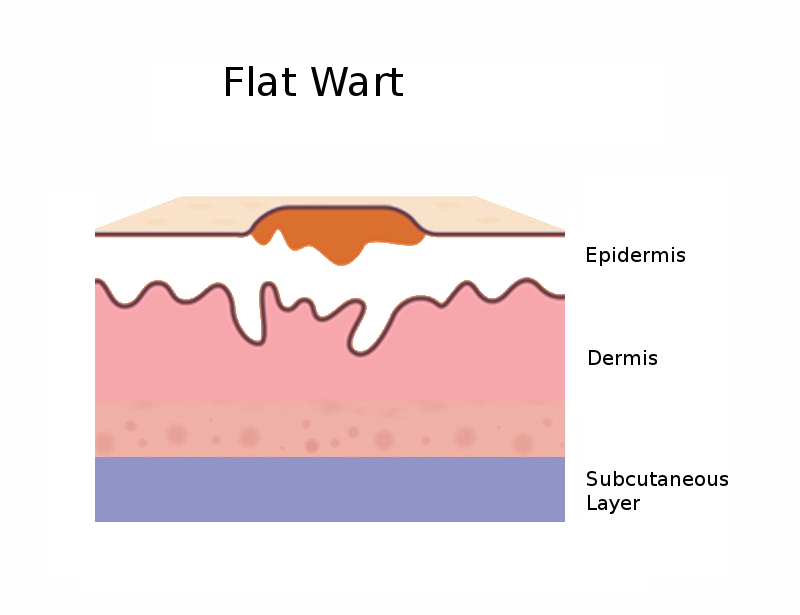 Diagram side view of a flat wart