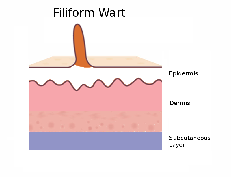 Diagram side view of a filiform wart