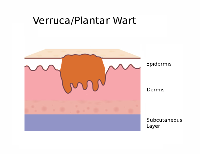 Diagram side view of a plantar wart / verruca