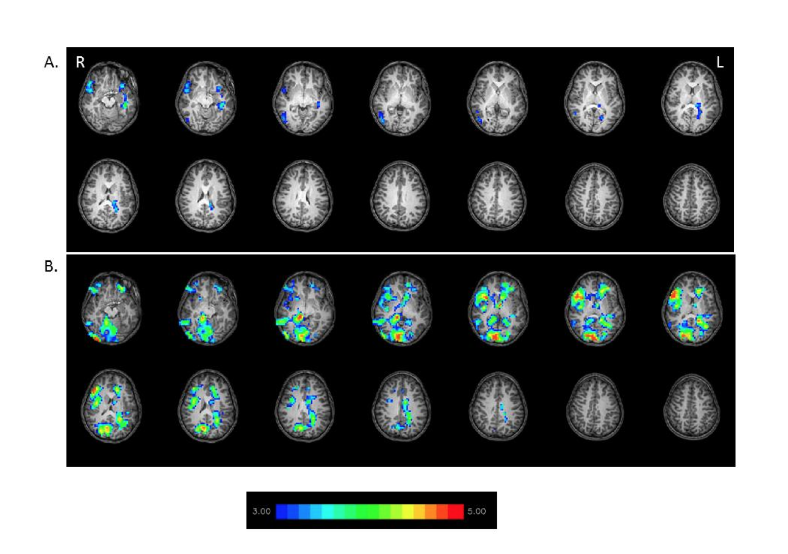 Figure 1: Differences between children with dyslexia and typical readers in words reading in fMRI (while using a contrast of words > pseudohomophones). T-test analysis for the brain activation of the two groups was performed. The analysis (p < .001, corrected) shows that a typical readers are using their left side of their brain more intensively, while individuals with dyslexia show more right-lateralized spread activation and greater activation in the frontal and occipital regions. Slice thickness is 5mm for these contiguous slices. Slices range from z=22 to z=35 in the Talairach frame. The hot color represents a more intense activation