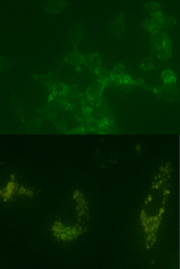 Figure 3. Digital images showing positive staining for beta-catenin within adenocarcinoma (top) and human bone marrow mesenchymal stem cell cultures (bottom).
