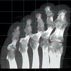 Figure 6: An image showing the bones of the human foot with some areas of low quality information, displayed with the sketch technique