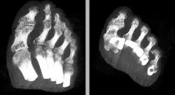 Figure 7: A pair of images showing the bones of a human foot in different orientations. The same region (in this example the bones of the big toe & the adjacent toe) has been illustratively rendered with the stipple technique in both images