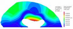 Fig 8: Poroelastic case study solid model showing displacement magnitude. The maximum solid displacement (red color regions) occurred in the center of the lateral edge of the ventricular wall.