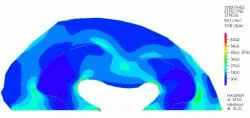 Fig 9: Linear elastic model showing effective stress which was greatest at the edges of the fixed portion of the slice and at the anterior and posterior horns of the lateral ventricles.