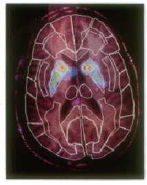 Fig. 8: Regions of interest in PET image of the brain, 5.2cm above the orbito-meatal line (Gjedde 1991).