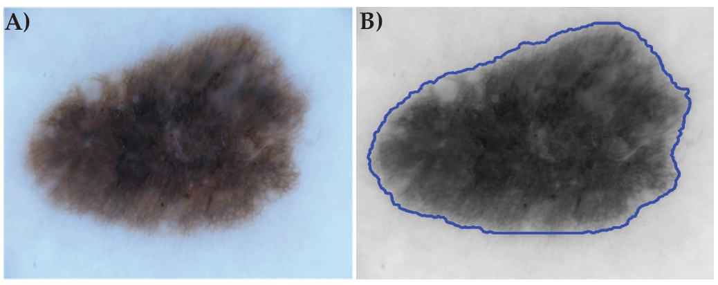 Figure 2. An example of an original color image of a lesion from ISIC 16 dataset (A) and its grayscale version used by the algorithm after pre-processing with ground truth segmentation outline in blue (B).