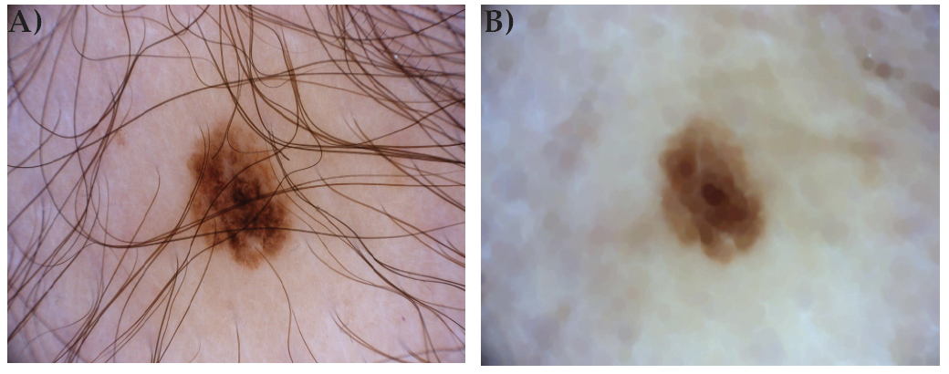Figure 4. Original image (A) and pre-processed image (B) from ISIC16 dataset (index 65).