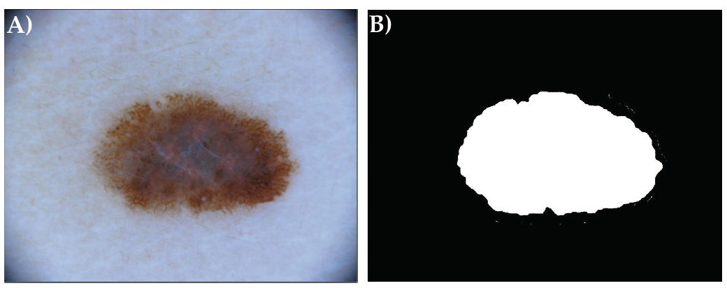 Figure 5. Original image (A) and color thresholded image (B) from ISIC16 dataset (index 24).