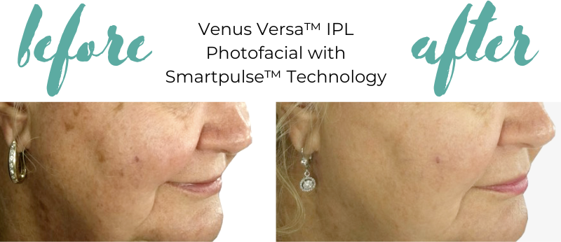 ladan-spa-venus-versa-before-after-2.png