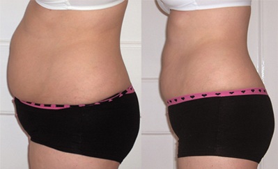 After 12 sessions 5 Inches lost, and 2 dress sizes smaller. 
