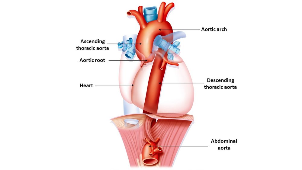The Aorta & TAAD — Genetic Aortic Disorders Association Canada