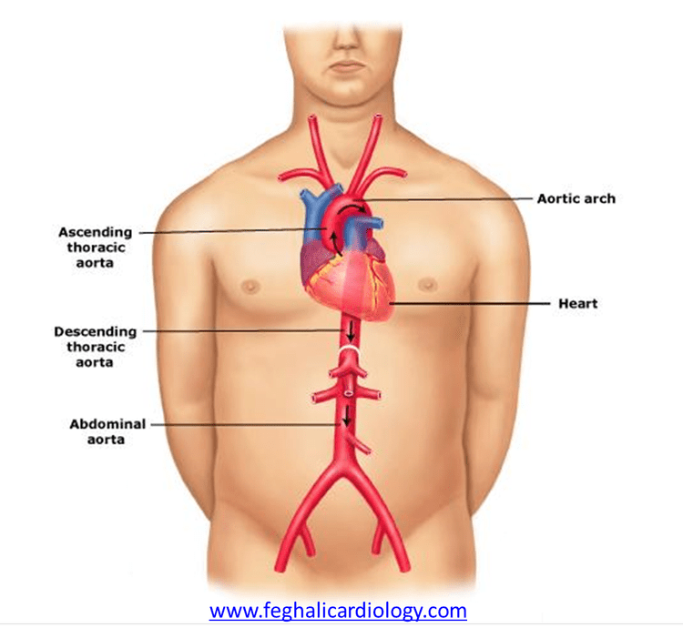 The Aorta & TAAD — Genetic Aortic Disorders Association Canada