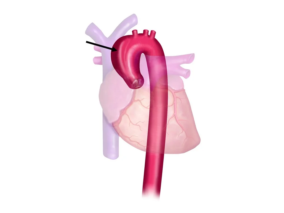 Figure 3a: Aortic Arch Aneurysm