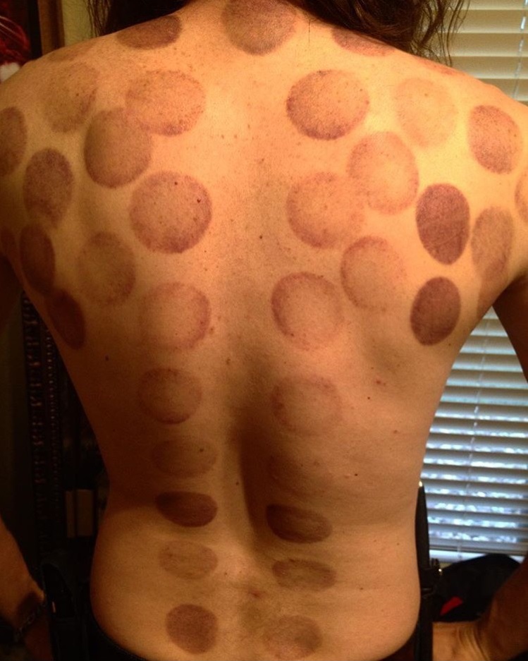 aftercupping.jpg