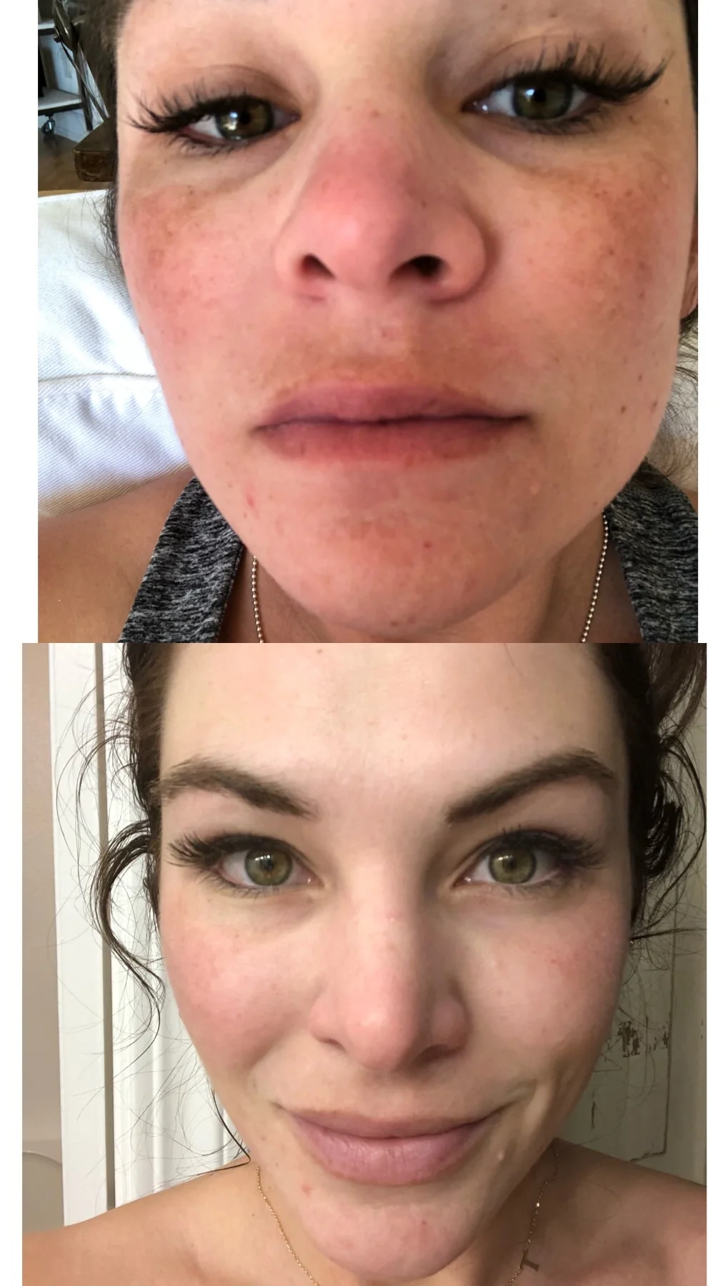 melasma skincare routine