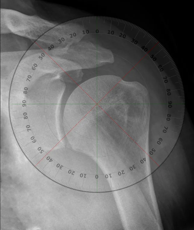 shoulder rom dial.jpg