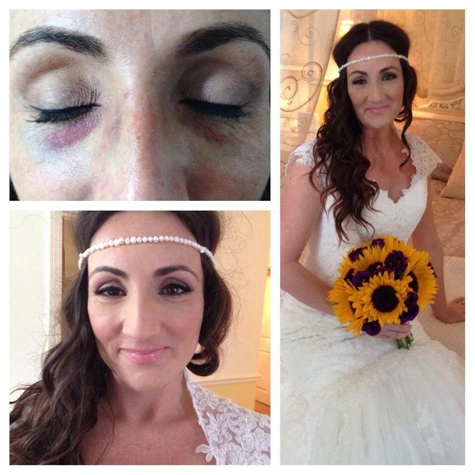 Covering up 2 bruised black eyes on my bride after being in an accident days before her big day! She was so pleased with the result.