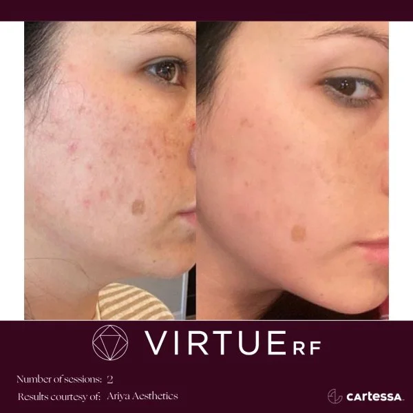 VirtueRFBAFemaleFaceAcne1.jpg