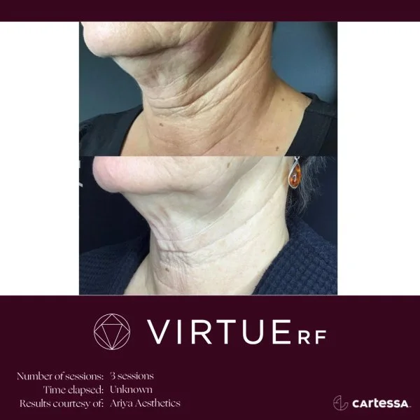 VirtueRFBAFemaleNeckWrinkles3.jpg