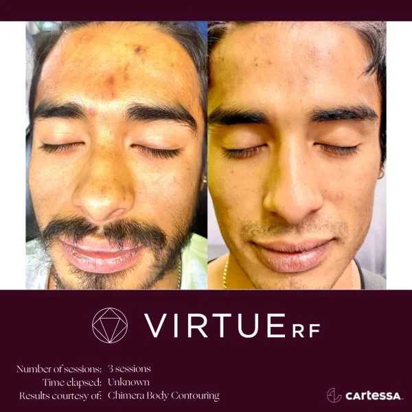 VirtueRFBAMaleFaceAcneScars.jpg