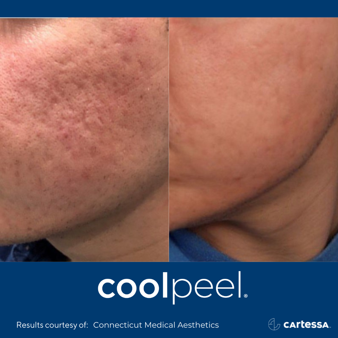 CoolPeel Laser Beauty Bar By Heather New Bern NC Beauty Bar By coolpeel-laser-beauty-bar-by-heather-new-bern-nc-beauty-bar-by