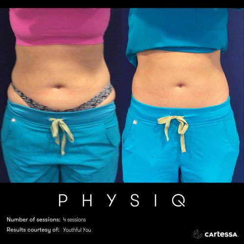 Exclusive Before & After Physiq Body Treatments