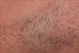 Underarm Before