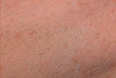 Underarm After