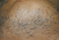 Male Chin Before