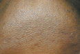 Male Chin After