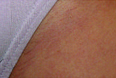 Bikini Line After
