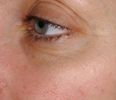 1 Month After the Third/Final Treatment