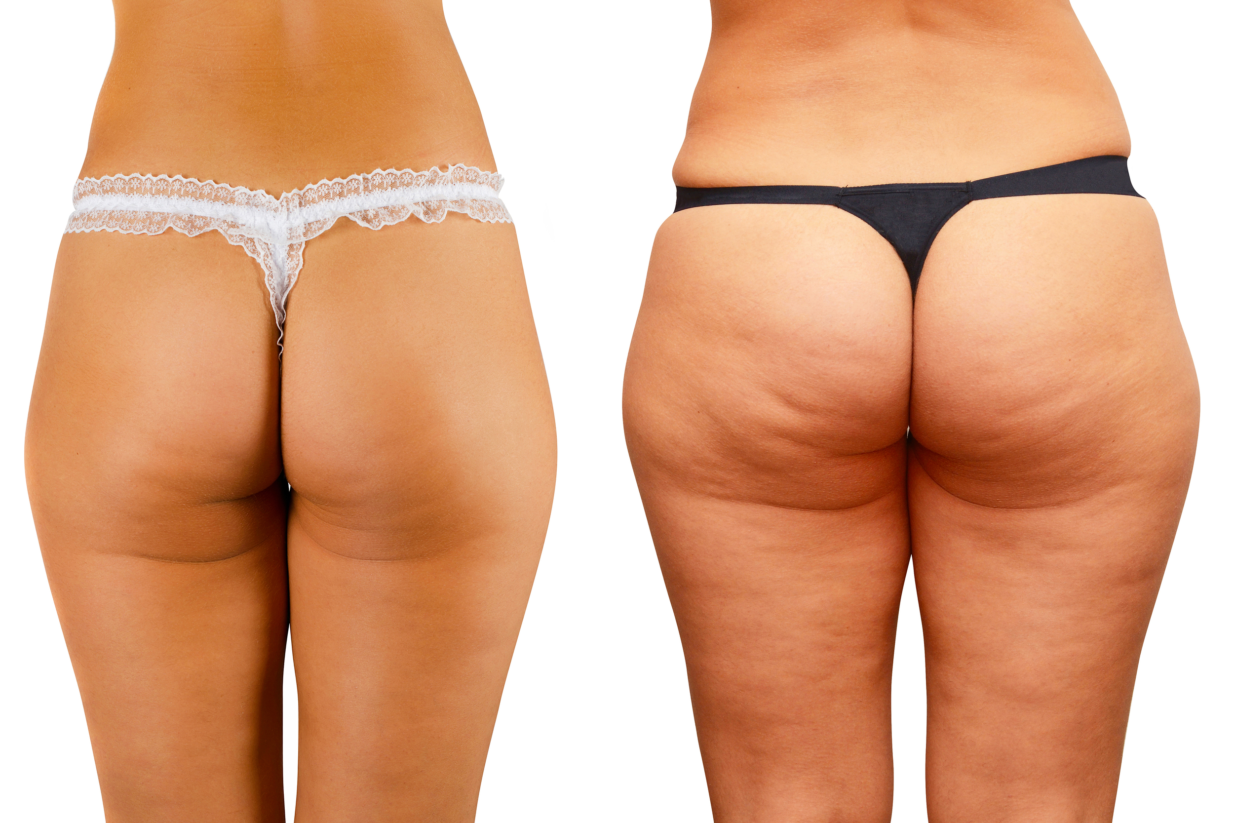 Cellulite Grade 1 to 3