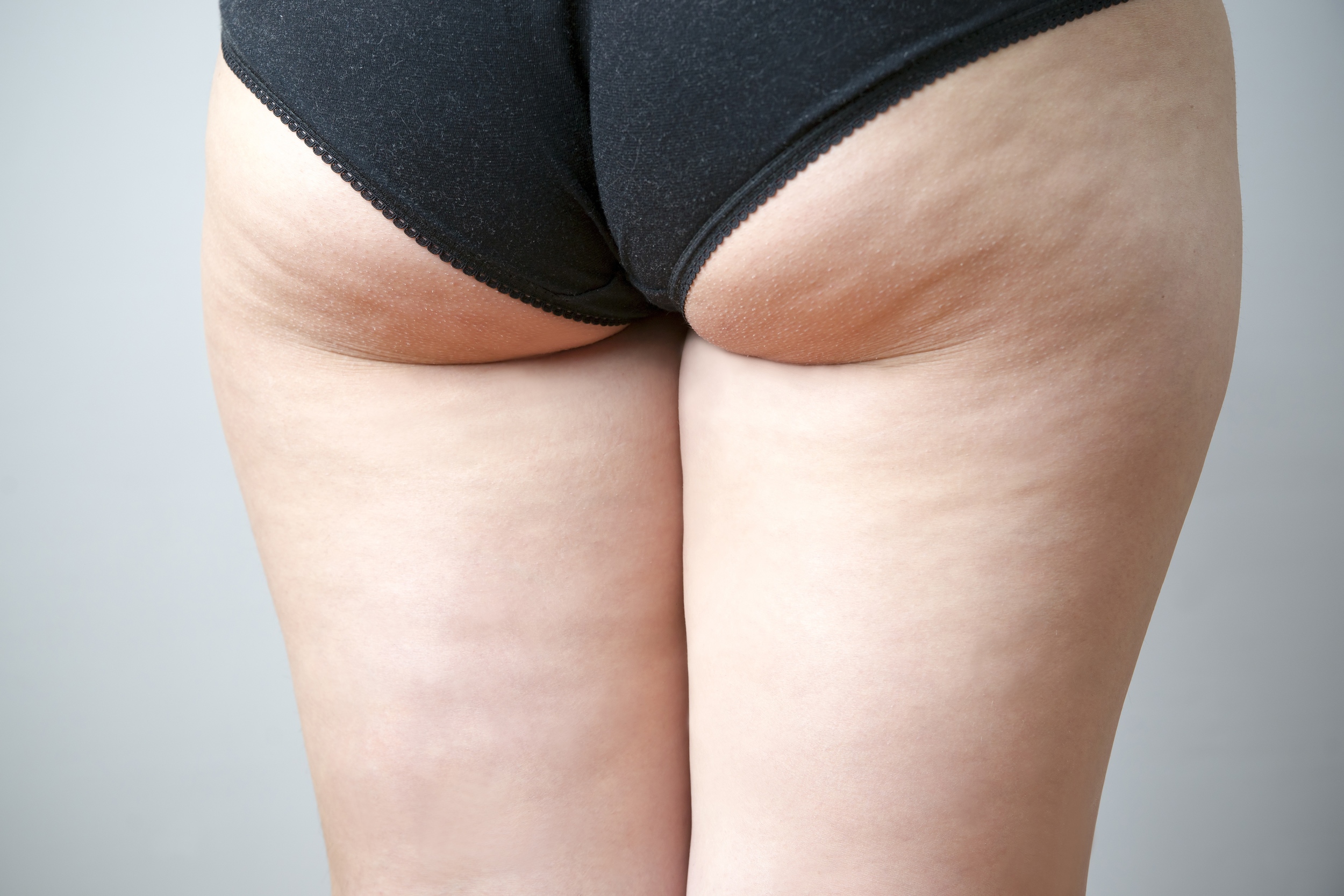 Cellulite Grade 2
