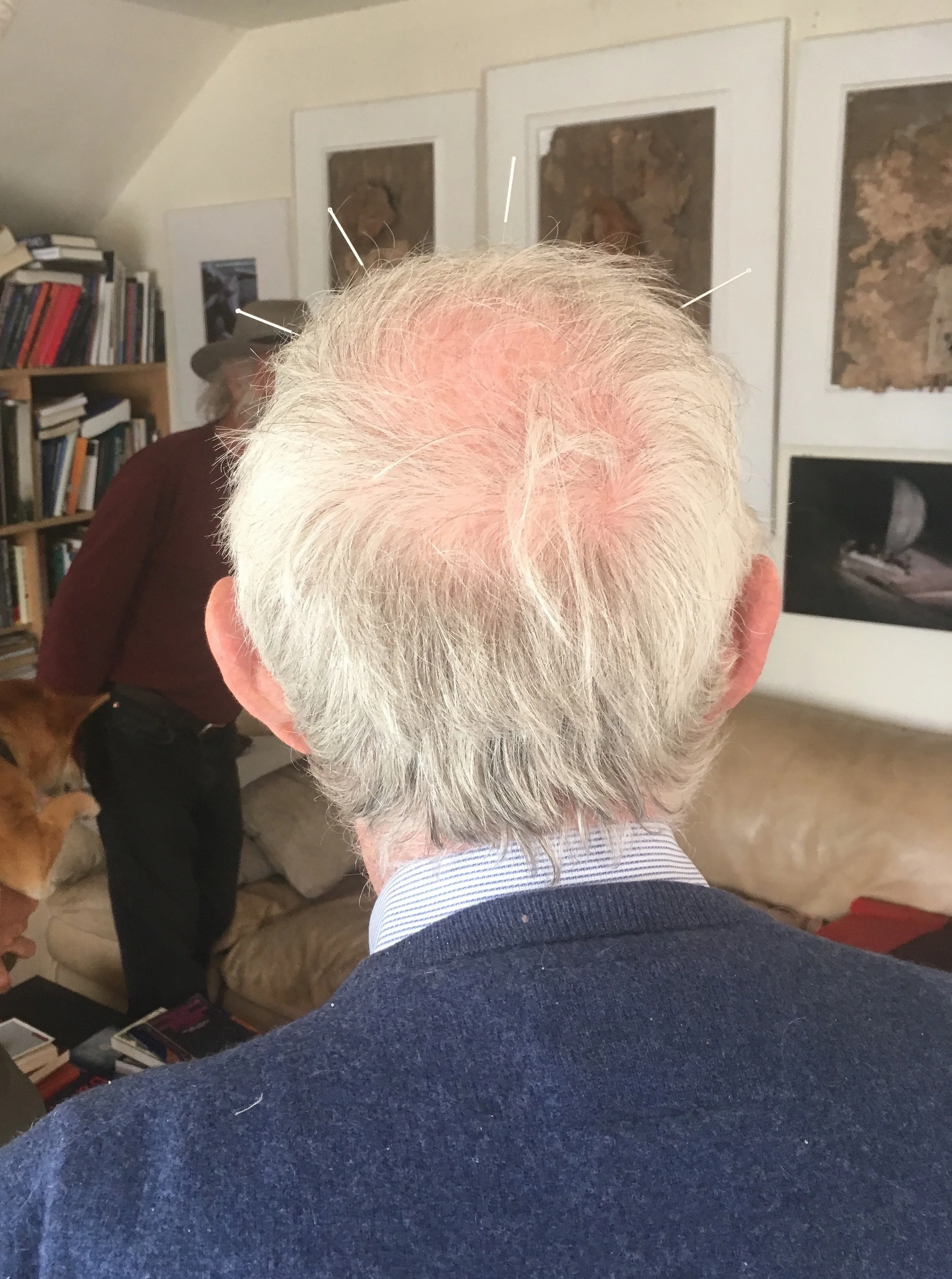 The back of the German acupuncturists head, sporting 4 acupuncture needles
