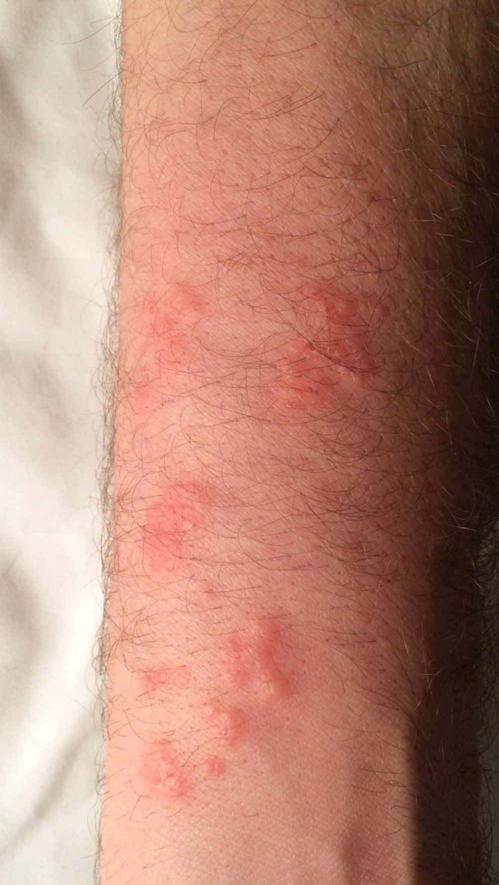 Bed Bug Cluster Bites