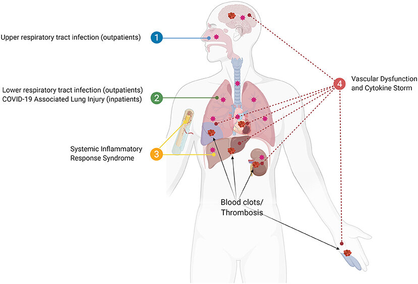 Polidoro et al, 2020: Systemic inflammatory response and COVID-19 outcomes