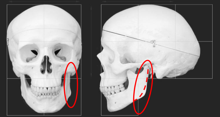 The dotted line is how the jaw appears as you age - much smoother and less defined.