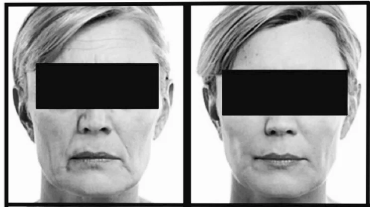 cheek fillers lancashire