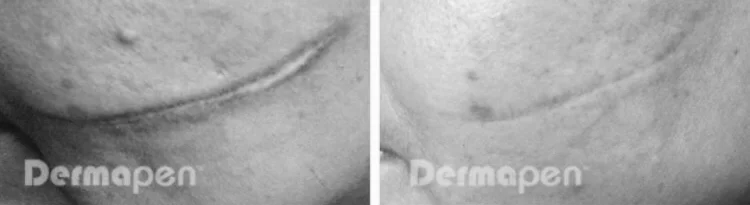 before and after scar.jpg