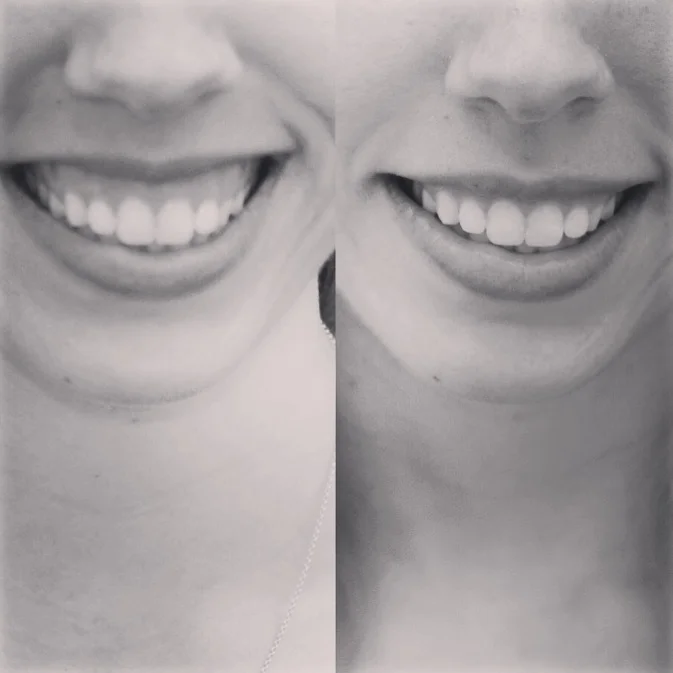 gummy smiles lancashire.JPG